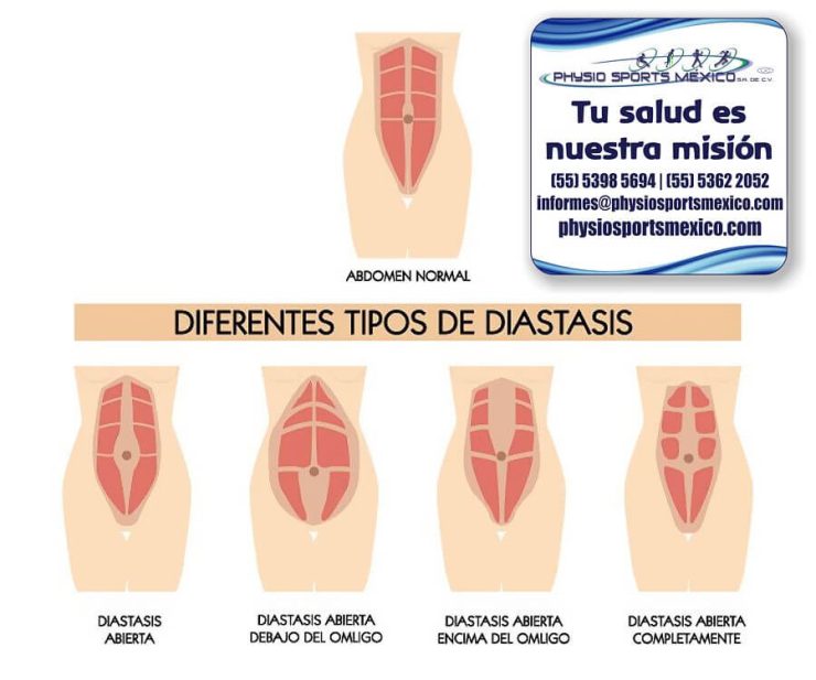 Diástasis abdominal postparto y fisioterapia dermatofuncional Physio Sports MX